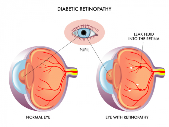 comparision of a normal eye to a eye with retinopathy